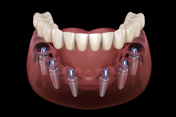 Dental implant model showing prosthetic teeth on lower jaw with multiple titanium implant posts anchored in gums.