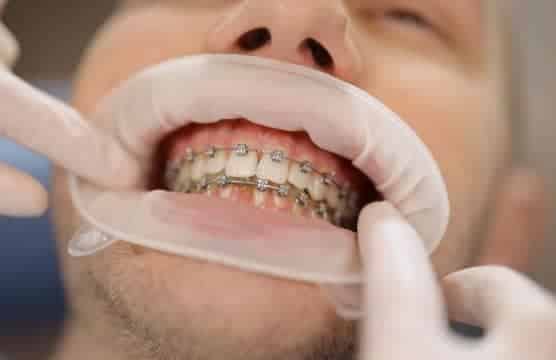 patient getting braces treatment