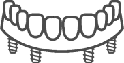 Dental implant bridge illustration showing prosthetic teeth supported by multiple implants for tooth replacement.