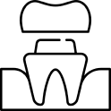 Dental crown diagram showing tooth restoration procedure with crown placement on tooth structure.