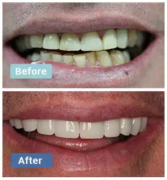 Before and after dental treatment comparison showing improved teeth whitening and alignment by Aloha Dental Las Vegas.
