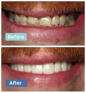 Before and after dental comparison showing teeth whitening results at Aloha Dental Las Vegas